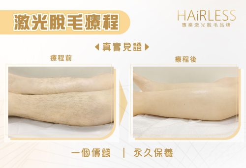 01-Blog 脫毛邊間好_All_E