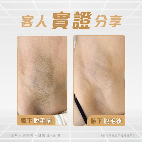 07-Blog--腋下美白(photo3)